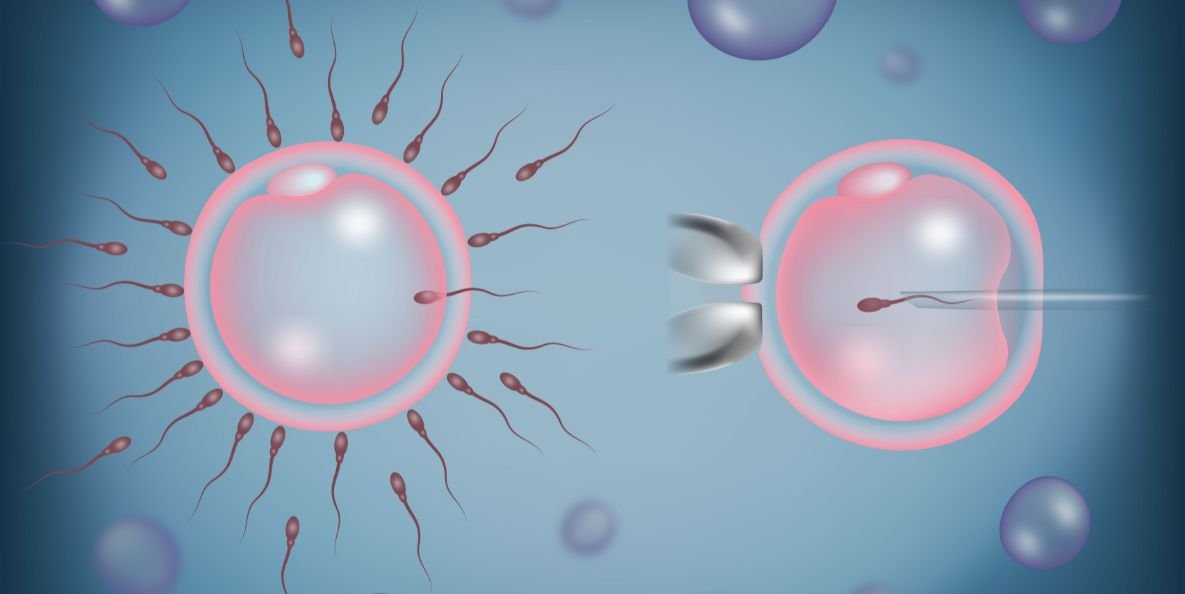 Illustration showing two fertilization methods: natural sperm penetration of the egg on the left and ICSI on the right, where a single sperm is injected directly into the egg using a fine needle.