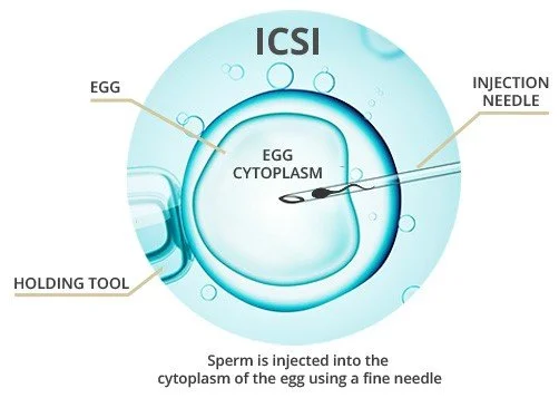 Illustration of the ICSI procedure showing a sperm being injected into an egg’s cytoplasm using a fine needle.