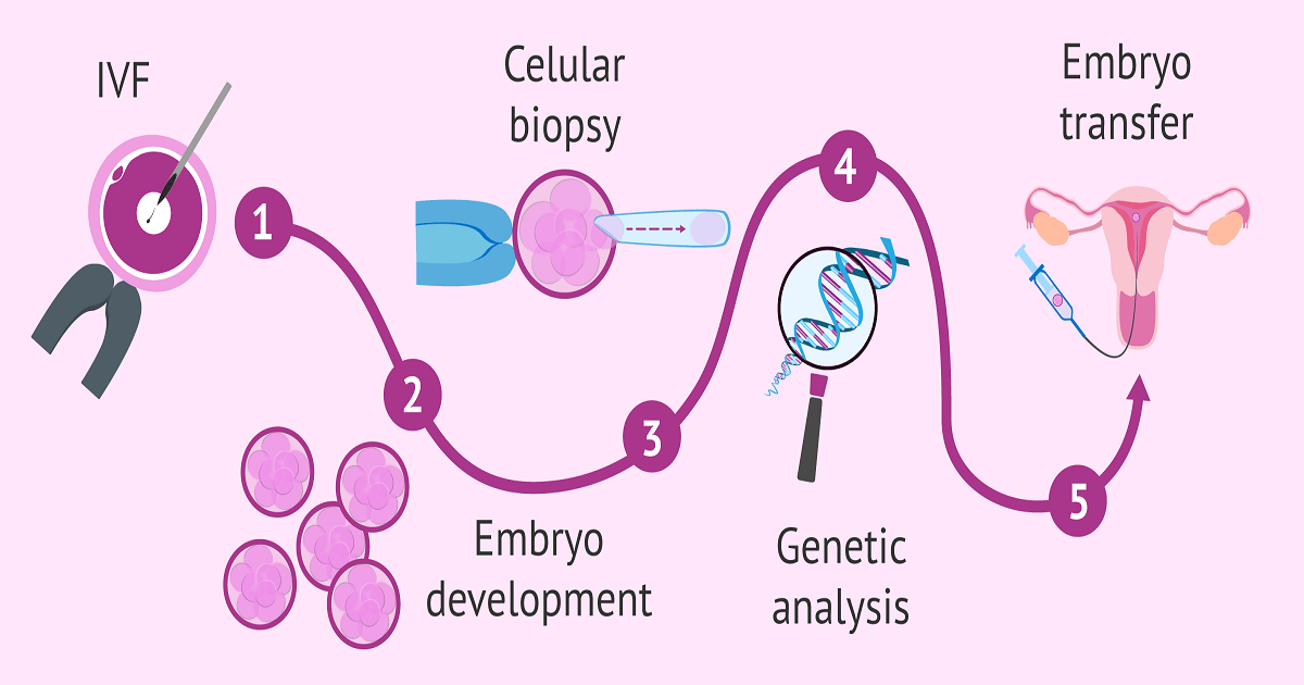 Illustration showing the steps of IVF and PGT, including egg fertilization, embryo development, cellular biopsy, genetic analysis, and embryo transfer into the uterus.