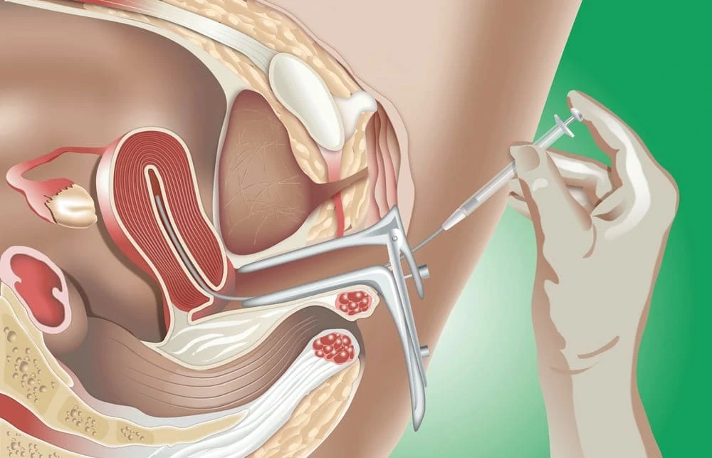 Medical illustration showing an intrauterine insemination (IUI) procedure with a speculum and catheter inserted into the uterus.