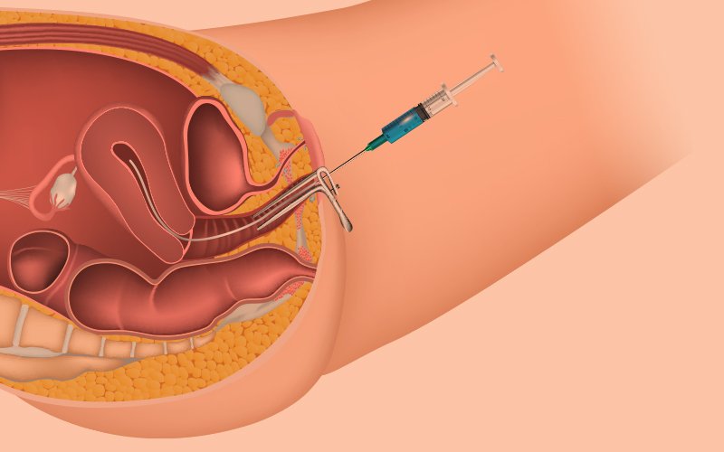Medical illustration showing the process of in vitro maturation (IVM), where immature oocytes are retrieved from the ovary using a needle guided through the vaginal wall.